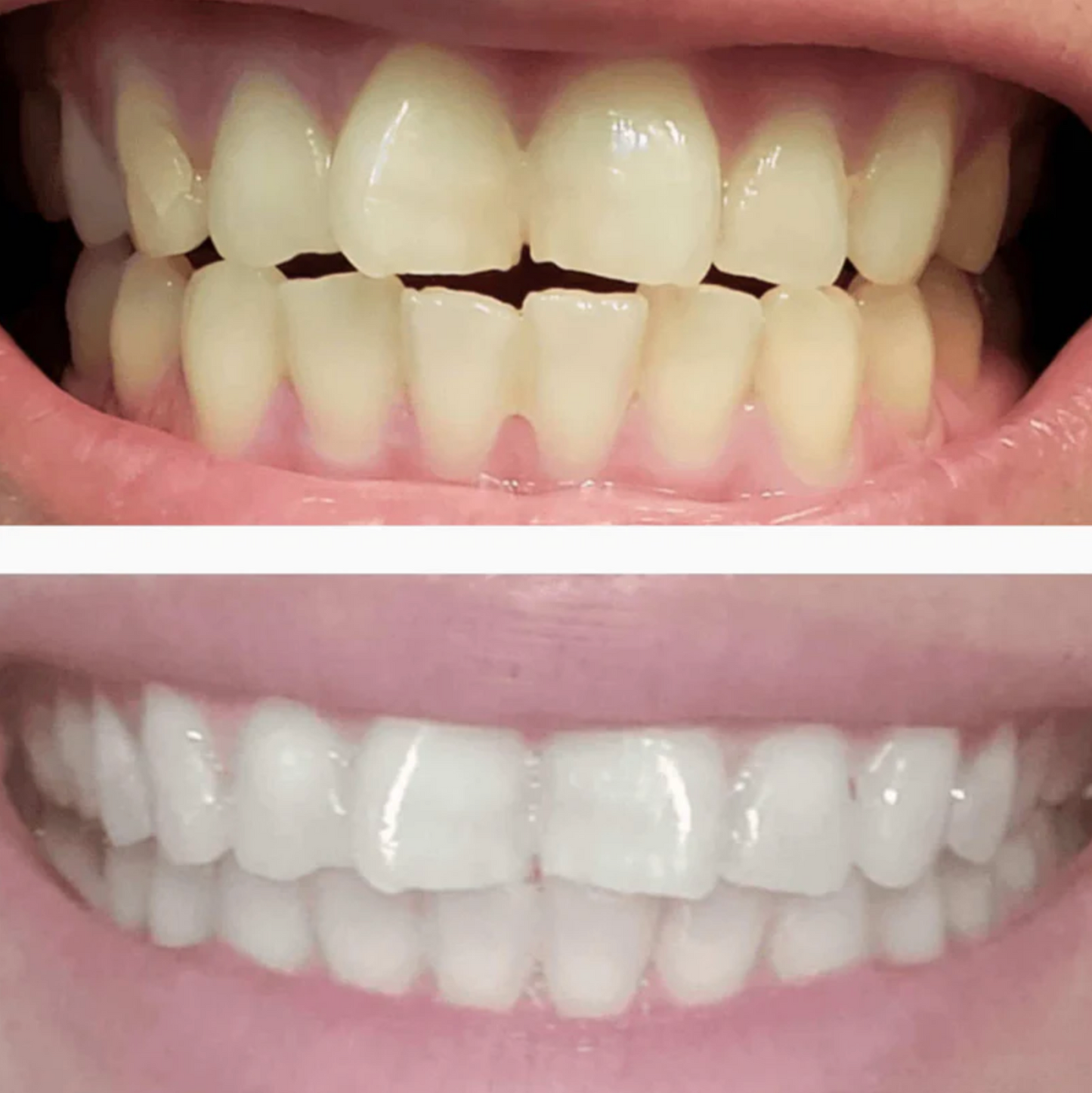 DiamondSeries® Teeth Whitening Serum Pen